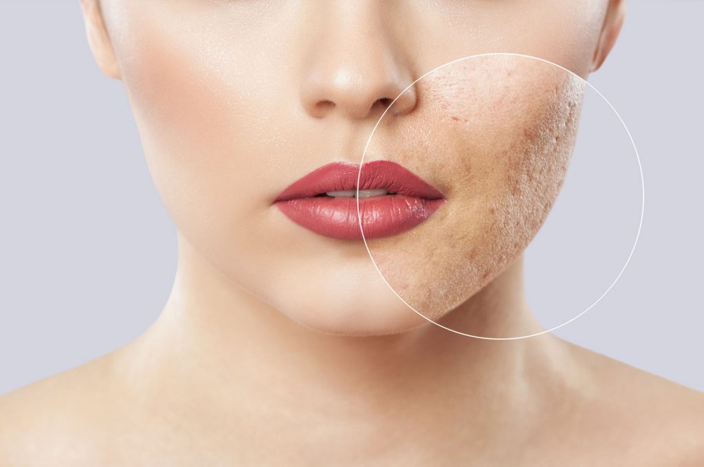 Scar Removal Laser