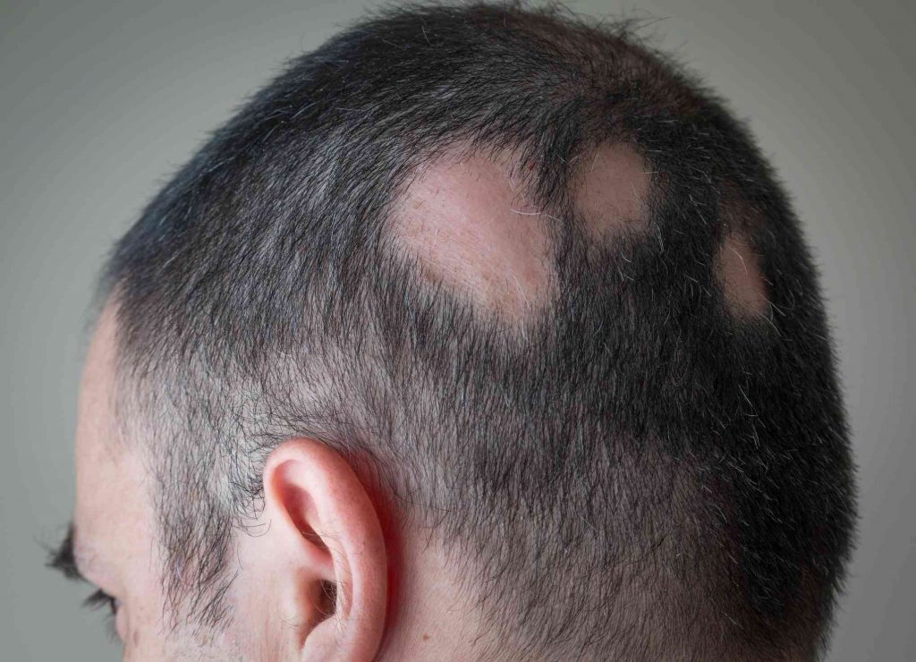 alopecia treatment