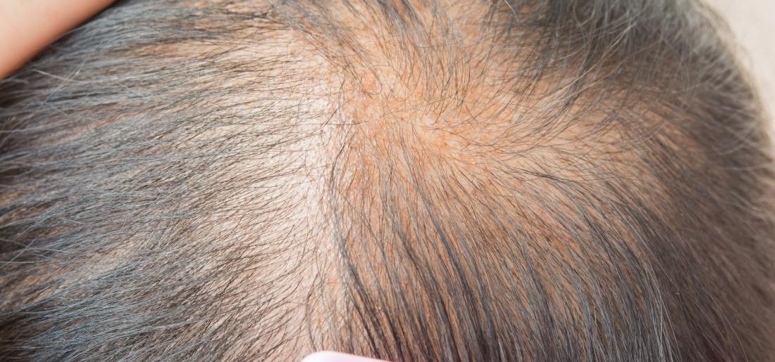 How To Look For The Best Alopecia Treatment For Hair Loss?