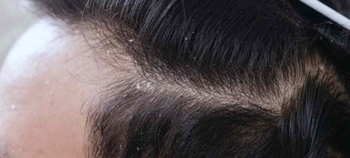 What You Should Know About Dry Scalp Treatment NZ